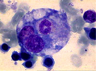 Hemophagocytosis_1